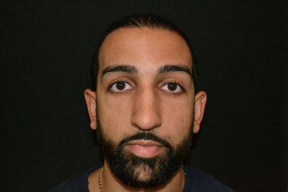 Rhinoplasty Before & After Patient #19620