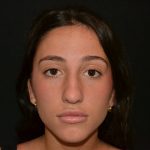 Rhinoplasty Before & After Patient #19622