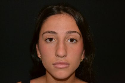 Rhinoplasty Before & After Patient #19622