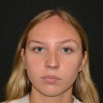 Rhinoplasty Before & After Patient #19623