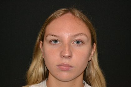 Rhinoplasty Before & After Patient #19623