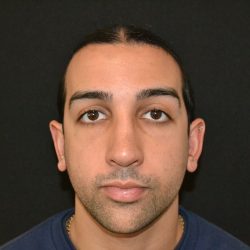 Rhinoplasty Before & After Patient #19620