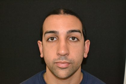 Rhinoplasty Before & After Patient #19620