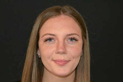 Rhinoplasty Before & After Patient #19619