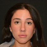 Rhinoplasty Before & After Patient #19622
