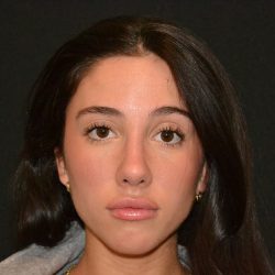 Rhinoplasty Before & After Patient #19622