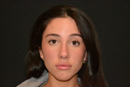 Rhinoplasty Before & After Patient #19622