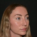 Rhinoplasty Before & After Patient #19627