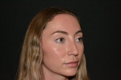 Rhinoplasty Before & After Patient #19627