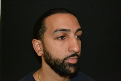 Rhinoplasty Before & After Patient #19620