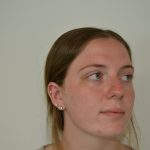 Rhinoplasty Before & After Patient #19619