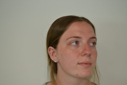 Rhinoplasty Before & After Patient #19619
