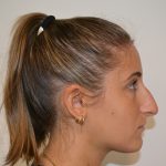Rhinoplasty Before & After Patient #19621