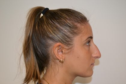 Rhinoplasty Before & After Patient #19621