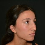 Rhinoplasty Before & After Patient #19622