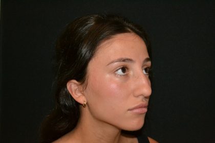 Rhinoplasty Before & After Patient #19622