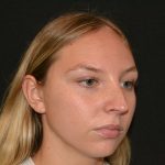 Rhinoplasty Before & After Patient #19623