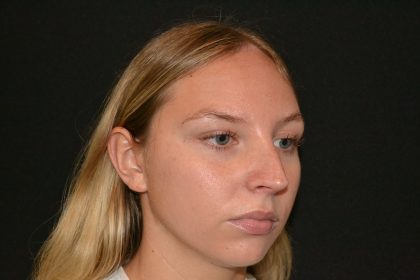 Rhinoplasty Before & After Patient #19623