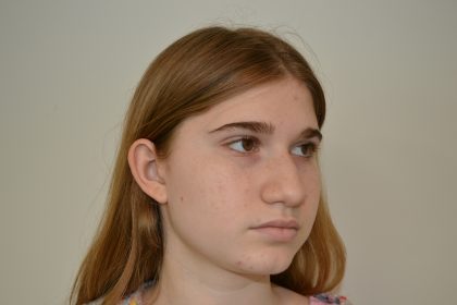 Rhinoplasty Before & After Patient #19625