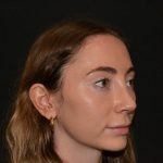 Rhinoplasty Before & After Patient #19627