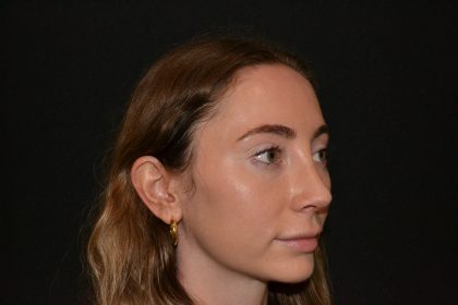 Rhinoplasty Before & After Patient #19627