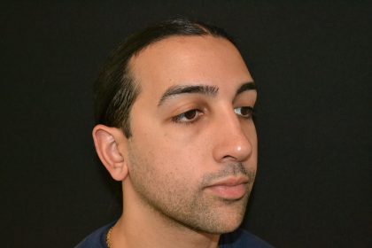 Rhinoplasty Before & After Patient #19620