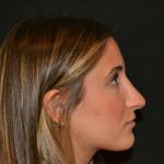Rhinoplasty Before & After Patient #19621