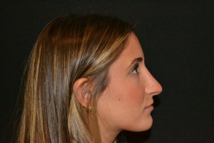 Rhinoplasty Before & After Patient #19621
