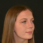 Rhinoplasty Before & After Patient #19619