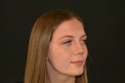 Rhinoplasty Before & After Patient #19619