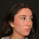 Rhinoplasty Before & After Patient #19622