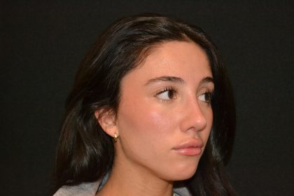 Rhinoplasty Before & After Patient #19622