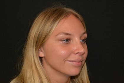 Rhinoplasty Before & After Patient #19623