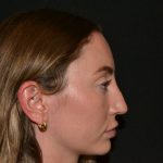 Rhinoplasty Before & After Patient #19627