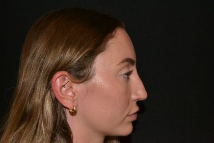 Rhinoplasty Before & After Patient #19627