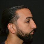 Rhinoplasty Before & After Patient #19620