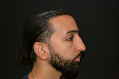Rhinoplasty Before & After Patient #19620