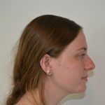 Rhinoplasty Before & After Patient #19619