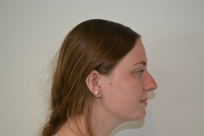 Rhinoplasty Before & After Patient #19619