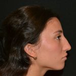 Rhinoplasty Before & After Patient #19622