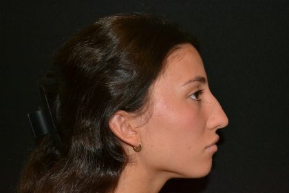 Rhinoplasty Before & After Patient #19622