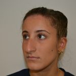 Rhinoplasty Before & After Patient #19621