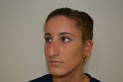 Rhinoplasty Before & After Patient #19621