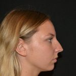 Rhinoplasty Before & After Patient #19623