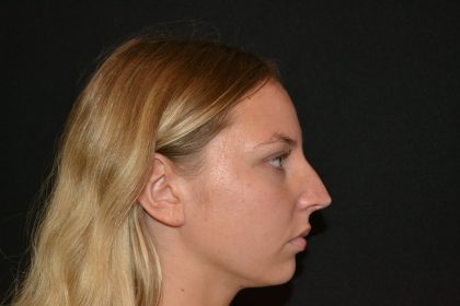 Rhinoplasty Before & After Patient #19623