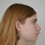 Rhinoplasty Before & After Patient #19625