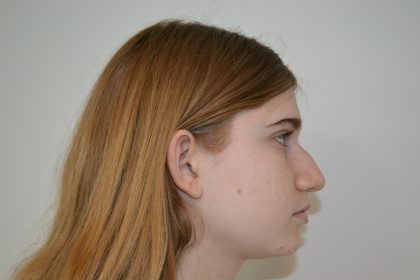 Rhinoplasty Before & After Patient #19625