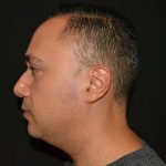 Chin Augmentation Before & After Patient #19626