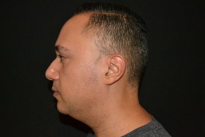 Chin Augmentation Before & After Patient #19626