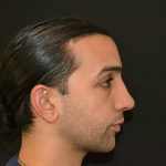 Rhinoplasty Before & After Patient #19620